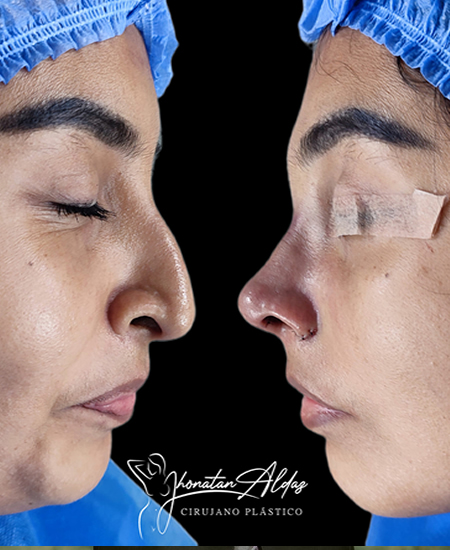 RINOPLASTIA-ULTRASONICA-GUAYAQUIL