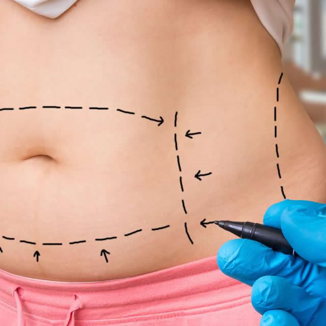LIPOSUCCION GUAYAQUIL